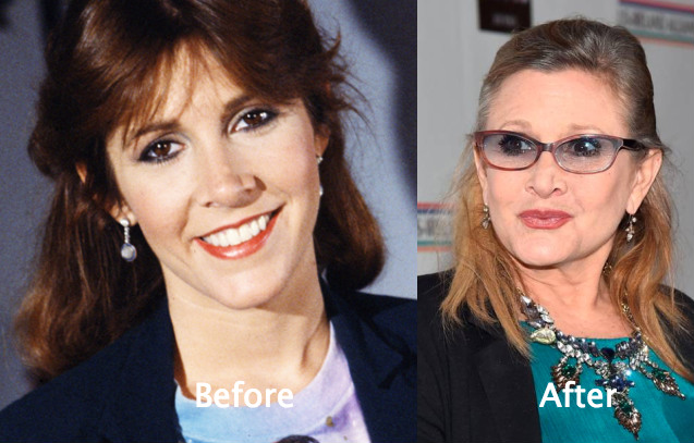 Carrie Fisher’s Plastic Surgery